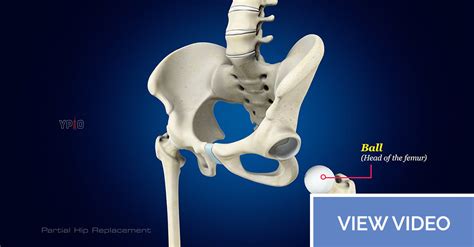 hip replacement rhode island|Iba pa.